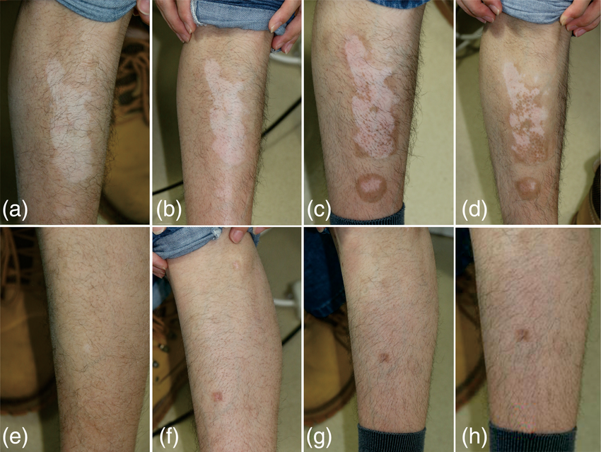 Laser Fractional CO2 (1)