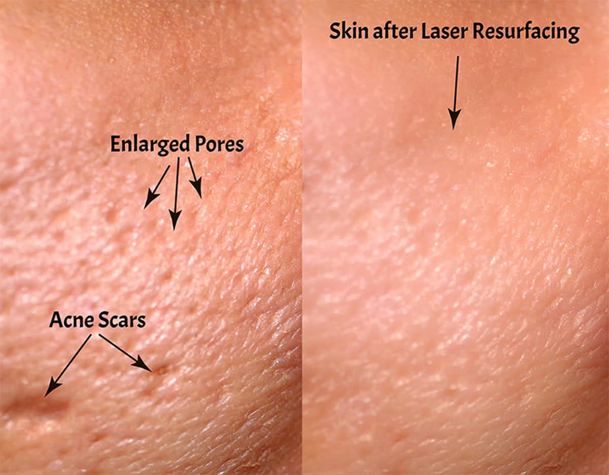 Laser Fractional CO2 (2)