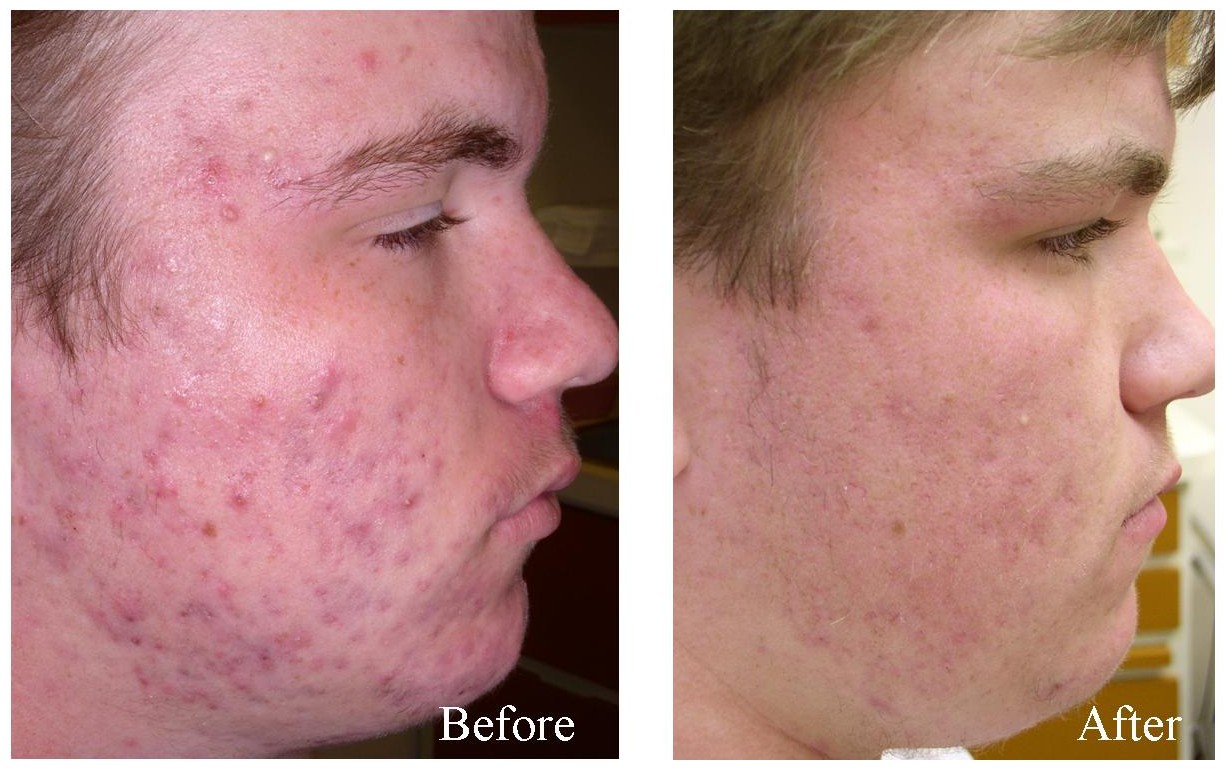 Laser Fractional CO2 (3)