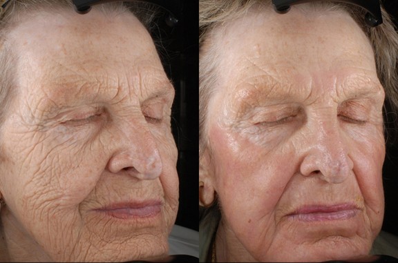 Laser Fractional CO2 (4)